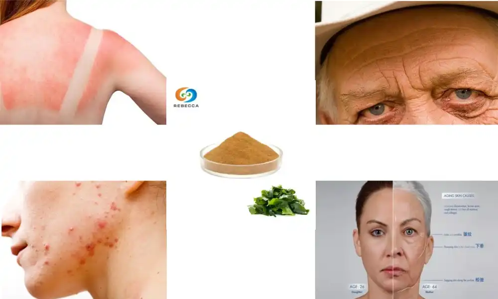 Can fucoxanthin help with skin conditions like hyperpigmentation?